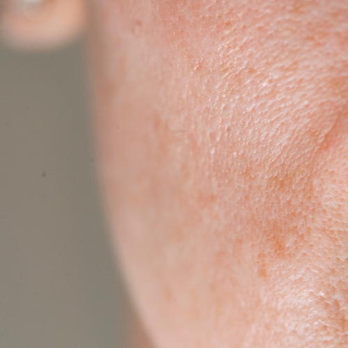 ¿Pueden los Péptidos de Colágeno ayudar con la Rosácea y la piel sensible?